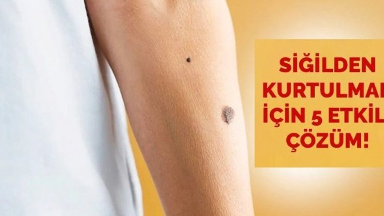 Siğilleri Yok Eden Doğal ve Etkili Çözümler