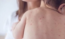 Bu belirtilere dikkat: Okullarda suçiçeği alarmı