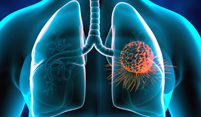 Akciğer kanseri riskine karşı 7 önlem