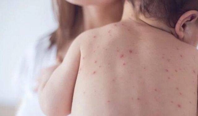 Bu belirtilere dikkat: Okullarda suçiçeği alarmı