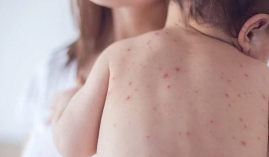 Bu belirtilere dikkat: Okullarda suçiçeği alarmı